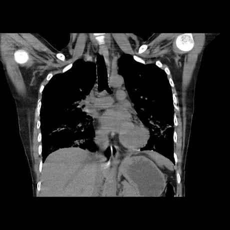 NEUMOPATIA INTERSTICIAL PROBABLE ETIOLOGIA HIPERSENSITIVA VS AUTOINMUNE/BACTERIANA/FUNGICA.