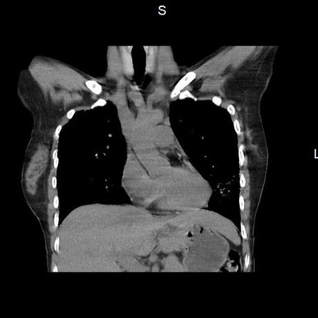 NEUMOPATIA INTERSTICIAL PROBABLE ETIOLOGIA HIPERSENSITIVA VS AUTOINMUNE/BACTERIANA/FUNGICA.