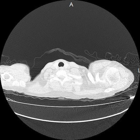 NEUMOPATIA INTERSTICIAL PROBABLE ETIOLOGIA HIPERSENSITIVA VS AUTOINMUNE/BACTERIANA/FUNGICA.