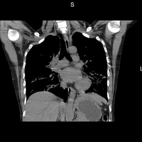 NEUMOPATIA INTERSTICIAL PROBABLE ETIOLOGIA HIPERSENSITIVA VS AUTOINMUNE/BACTERIANA/FUNGICA.