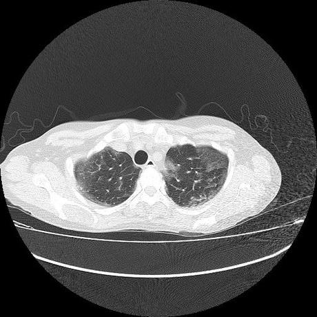 NEUMOPATIA INTERSTICIAL PROBABLE ETIOLOGIA HIPERSENSITIVA VS AUTOINMUNE/BACTERIANA/FUNGICA.