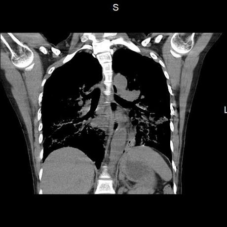 NEUMOPATIA INTERSTICIAL PROBABLE ETIOLOGIA HIPERSENSITIVA VS AUTOINMUNE/BACTERIANA/FUNGICA.