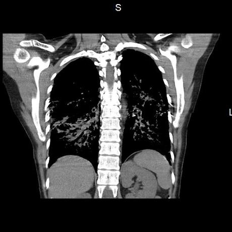 NEUMOPATIA INTERSTICIAL PROBABLE ETIOLOGIA HIPERSENSITIVA VS AUTOINMUNE/BACTERIANA/FUNGICA.