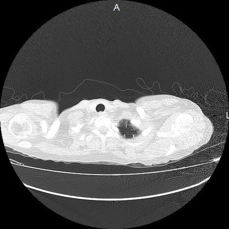 NEUMOPATIA INTERSTICIAL PROBABLE ETIOLOGIA HIPERSENSITIVA VS AUTOINMUNE/BACTERIANA/FUNGICA.