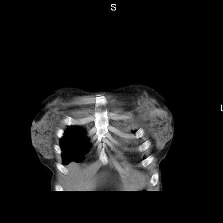 NEUMOPATIA INTERSTICIAL PROBABLE ETIOLOGIA HIPERSENSITIVA VS AUTOINMUNE/BACTERIANA/FUNGICA.