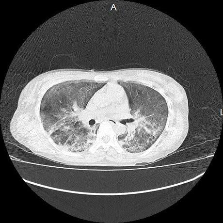 NEUMOPATIA INTERSTICIAL PROBABLE ETIOLOGIA HIPERSENSITIVA VS AUTOINMUNE/BACTERIANA/FUNGICA.