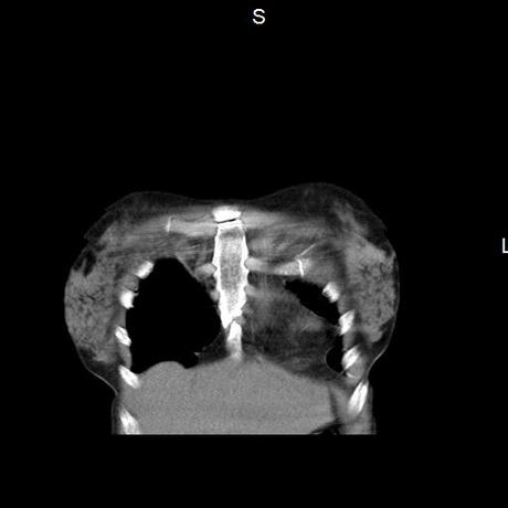 NEUMOPATIA INTERSTICIAL PROBABLE ETIOLOGIA HIPERSENSITIVA VS AUTOINMUNE/BACTERIANA/FUNGICA.