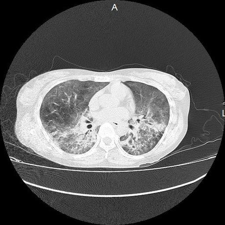 NEUMOPATIA INTERSTICIAL PROBABLE ETIOLOGIA HIPERSENSITIVA VS AUTOINMUNE/BACTERIANA/FUNGICA.