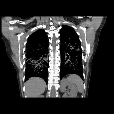 NEUMOPATIA INTERSTICIAL PROBABLE ETIOLOGIA HIPERSENSITIVA VS AUTOINMUNE/BACTERIANA/FUNGICA.