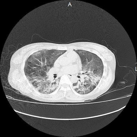 NEUMOPATIA INTERSTICIAL PROBABLE ETIOLOGIA HIPERSENSITIVA VS AUTOINMUNE/BACTERIANA/FUNGICA.