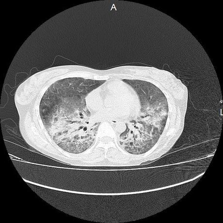 NEUMOPATIA INTERSTICIAL PROBABLE ETIOLOGIA HIPERSENSITIVA VS AUTOINMUNE/BACTERIANA/FUNGICA.