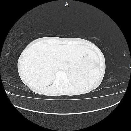 NEUMOPATIA INTERSTICIAL PROBABLE ETIOLOGIA HIPERSENSITIVA VS AUTOINMUNE/BACTERIANA/FUNGICA.