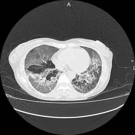 NEUMOPATIA INTERSTICIAL PROBABLE ETIOLOGIA HIPERSENSITIVA VS AUTOINMUNE/BACTERIANA/FUNGICA.