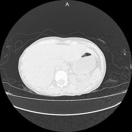 NEUMOPATIA INTERSTICIAL PROBABLE ETIOLOGIA HIPERSENSITIVA VS AUTOINMUNE/BACTERIANA/FUNGICA.