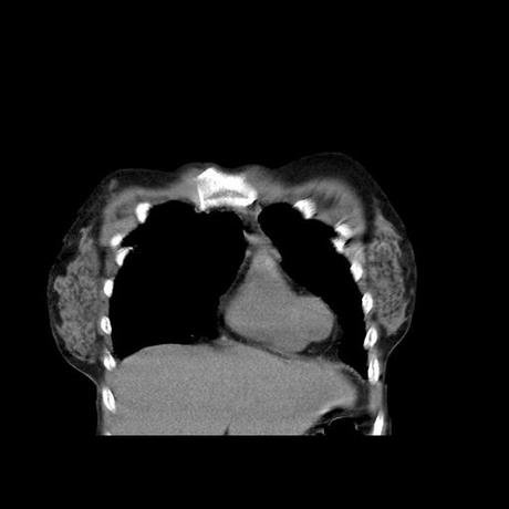 NEUMOPATIA INTERSTICIAL PROBABLE ETIOLOGIA HIPERSENSITIVA VS AUTOINMUNE/BACTERIANA/FUNGICA.