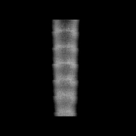 NEUMOPATIA INTERSTICIAL PROBABLE ETIOLOGIA HIPERSENSITIVA VS AUTOINMUNE/BACTERIANA/FUNGICA.