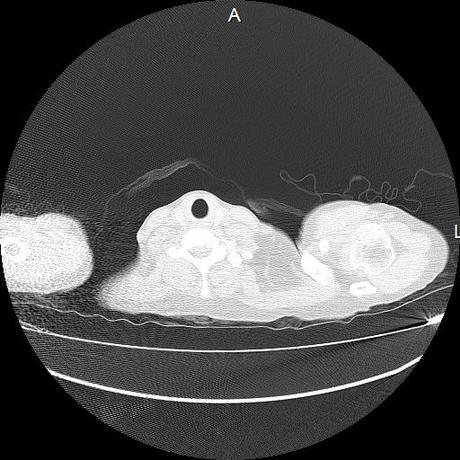 NEUMOPATIA INTERSTICIAL PROBABLE ETIOLOGIA HIPERSENSITIVA VS AUTOINMUNE/BACTERIANA/FUNGICA.