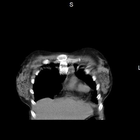 NEUMOPATIA INTERSTICIAL PROBABLE ETIOLOGIA HIPERSENSITIVA VS AUTOINMUNE/BACTERIANA/FUNGICA.