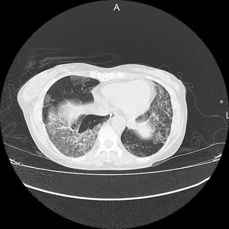 NEUMOPATIA INTERSTICIAL PROBABLE ETIOLOGIA HIPERSENSITIVA VS AUTOINMUNE/BACTERIANA/FUNGICA.