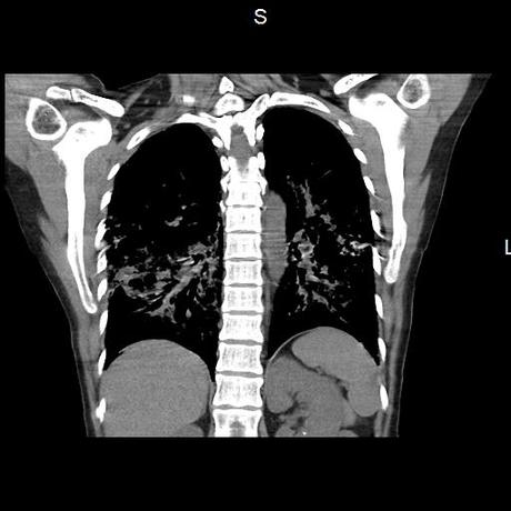 NEUMOPATIA INTERSTICIAL PROBABLE ETIOLOGIA HIPERSENSITIVA VS AUTOINMUNE/BACTERIANA/FUNGICA.