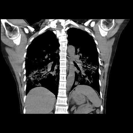 NEUMOPATIA INTERSTICIAL PROBABLE ETIOLOGIA HIPERSENSITIVA VS AUTOINMUNE/BACTERIANA/FUNGICA.