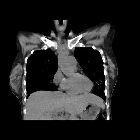 NEUMOPATIA INTERSTICIAL PROBABLE ETIOLOGIA HIPERSENSITIVA VS AUTOINMUNE/BACTERIANA/FUNGICA.