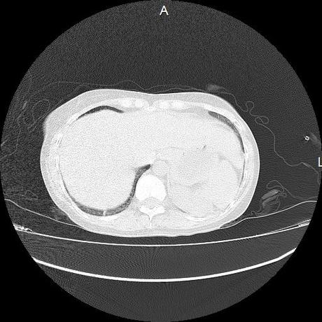 NEUMOPATIA INTERSTICIAL PROBABLE ETIOLOGIA HIPERSENSITIVA VS AUTOINMUNE/BACTERIANA/FUNGICA.