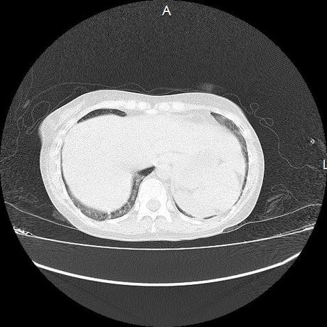 NEUMOPATIA INTERSTICIAL PROBABLE ETIOLOGIA HIPERSENSITIVA VS AUTOINMUNE/BACTERIANA/FUNGICA.