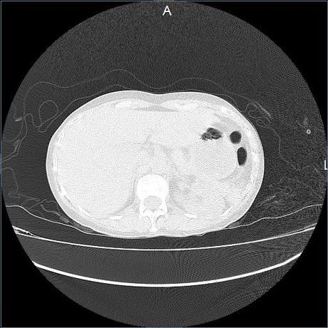 NEUMOPATIA INTERSTICIAL PROBABLE ETIOLOGIA HIPERSENSITIVA VS AUTOINMUNE/BACTERIANA/FUNGICA.