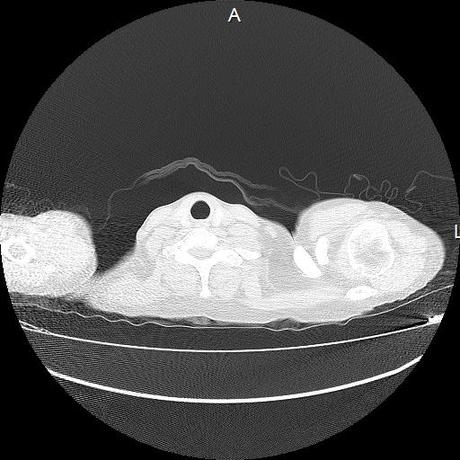 NEUMOPATIA INTERSTICIAL PROBABLE ETIOLOGIA HIPERSENSITIVA VS AUTOINMUNE/BACTERIANA/FUNGICA.