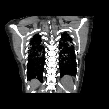 NEUMOPATIA INTERSTICIAL PROBABLE ETIOLOGIA HIPERSENSITIVA VS AUTOINMUNE/BACTERIANA/FUNGICA.