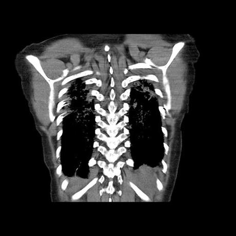 NEUMOPATIA INTERSTICIAL PROBABLE ETIOLOGIA HIPERSENSITIVA VS AUTOINMUNE/BACTERIANA/FUNGICA.
