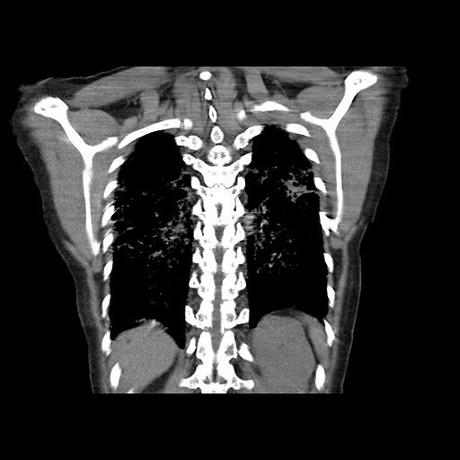 NEUMOPATIA INTERSTICIAL PROBABLE ETIOLOGIA HIPERSENSITIVA VS AUTOINMUNE/BACTERIANA/FUNGICA.