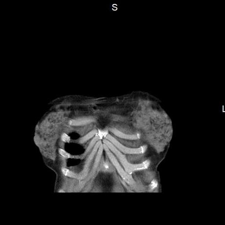 NEUMOPATIA INTERSTICIAL PROBABLE ETIOLOGIA HIPERSENSITIVA VS AUTOINMUNE/BACTERIANA/FUNGICA.