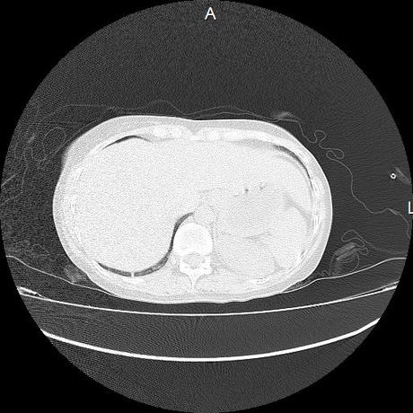 NEUMOPATIA INTERSTICIAL PROBABLE ETIOLOGIA HIPERSENSITIVA VS AUTOINMUNE/BACTERIANA/FUNGICA.