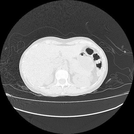 NEUMOPATIA INTERSTICIAL PROBABLE ETIOLOGIA HIPERSENSITIVA VS AUTOINMUNE/BACTERIANA/FUNGICA.