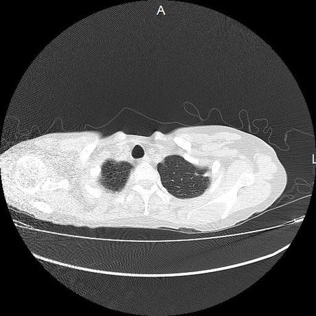 NEUMOPATIA INTERSTICIAL PROBABLE ETIOLOGIA HIPERSENSITIVA VS AUTOINMUNE/BACTERIANA/FUNGICA.