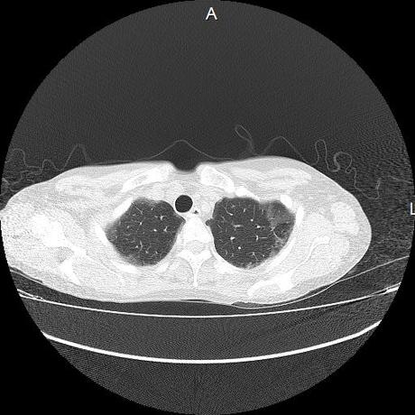 NEUMOPATIA INTERSTICIAL PROBABLE ETIOLOGIA HIPERSENSITIVA VS AUTOINMUNE/BACTERIANA/FUNGICA.