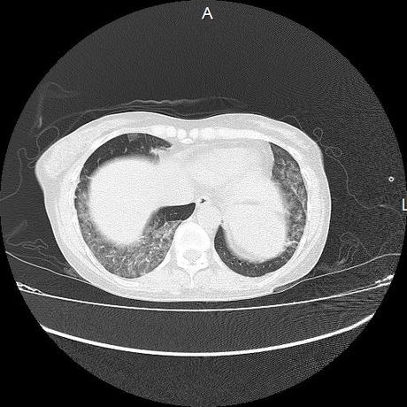 NEUMOPATIA INTERSTICIAL PROBABLE ETIOLOGIA HIPERSENSITIVA VS AUTOINMUNE/BACTERIANA/FUNGICA.