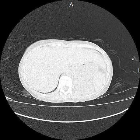 NEUMOPATIA INTERSTICIAL PROBABLE ETIOLOGIA HIPERSENSITIVA VS AUTOINMUNE/BACTERIANA/FUNGICA.