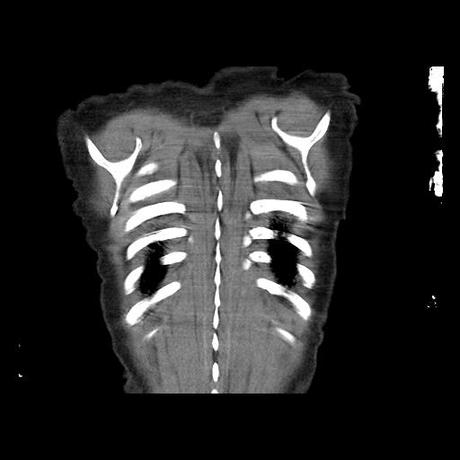 NEUMOPATIA INTERSTICIAL PROBABLE ETIOLOGIA HIPERSENSITIVA VS AUTOINMUNE/BACTERIANA/FUNGICA.