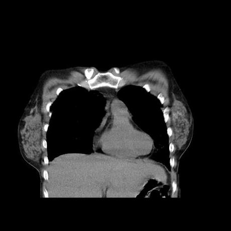 NEUMOPATIA INTERSTICIAL PROBABLE ETIOLOGIA HIPERSENSITIVA VS AUTOINMUNE/BACTERIANA/FUNGICA.