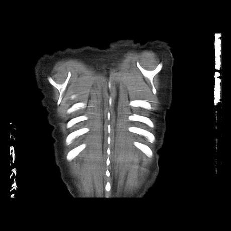 NEUMOPATIA INTERSTICIAL PROBABLE ETIOLOGIA HIPERSENSITIVA VS AUTOINMUNE/BACTERIANA/FUNGICA.