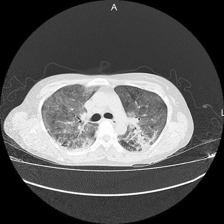 NEUMOPATIA INTERSTICIAL PROBABLE ETIOLOGIA HIPERSENSITIVA VS AUTOINMUNE/BACTERIANA/FUNGICA.