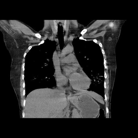 NEUMOPATIA INTERSTICIAL PROBABLE ETIOLOGIA HIPERSENSITIVA VS AUTOINMUNE/BACTERIANA/FUNGICA.