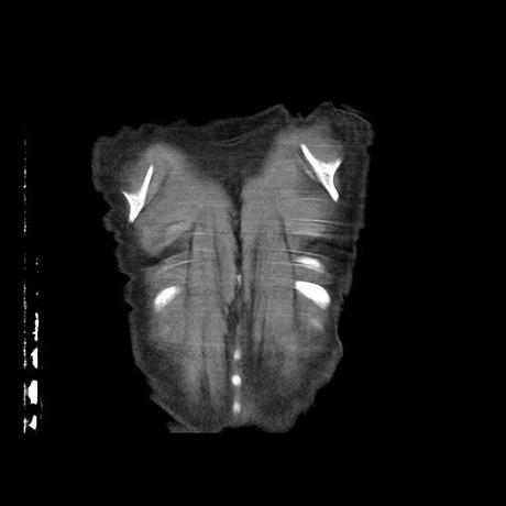 NEUMOPATIA INTERSTICIAL PROBABLE ETIOLOGIA HIPERSENSITIVA VS AUTOINMUNE/BACTERIANA/FUNGICA.