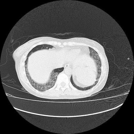 NEUMOPATIA INTERSTICIAL PROBABLE ETIOLOGIA HIPERSENSITIVA VS AUTOINMUNE/BACTERIANA/FUNGICA.