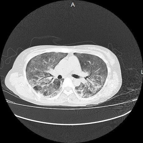 NEUMOPATIA INTERSTICIAL PROBABLE ETIOLOGIA HIPERSENSITIVA VS AUTOINMUNE/BACTERIANA/FUNGICA.