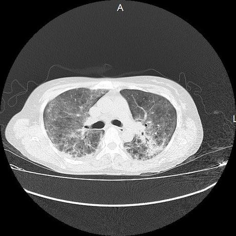 NEUMOPATIA INTERSTICIAL PROBABLE ETIOLOGIA HIPERSENSITIVA VS AUTOINMUNE/BACTERIANA/FUNGICA.