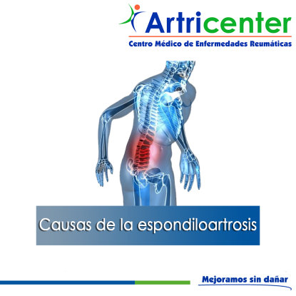 Artricenter: Causas de la espondiloartrosis